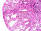 Se aprecia inflamación crónica pseudopoliposa de la mucosa colonica. Presionar sobre la imagen histopatológica para ampliarla.