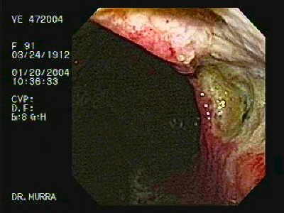 Ulcera Gástrica Gigante