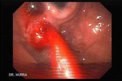 Endoscopia de severo sangrado por varice gástrica