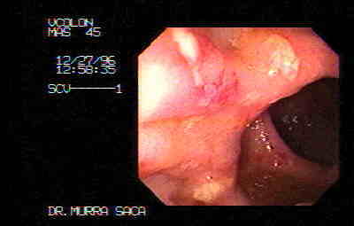 Ulceras rectales producidas por amebiasis.