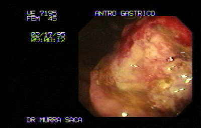 Extenso Adenocarcinoma ulcerado del antro