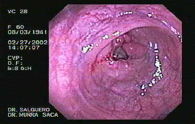Endoscopia de adenocarcinoma rectal