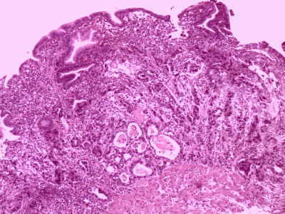 Litiasis de Vesícula Biliar y Adenocarcinoma. 