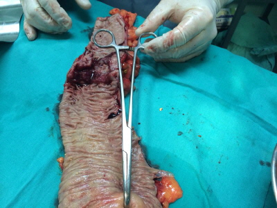 Adenocarcinoma del Colon Ascendente Se observa la pieza quirúrgica