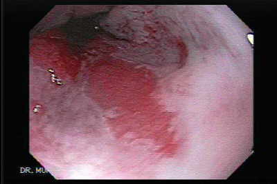 Esófago de Barrett y adenocarcinoma del esófago