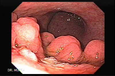 Metástasis de Adenocarcinoma del colon al estómago