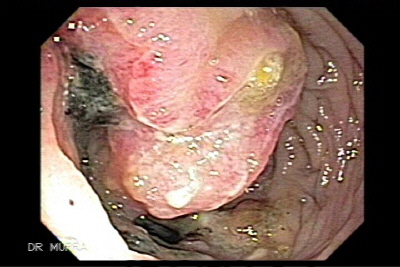adenocarcinoma del colon ascendente