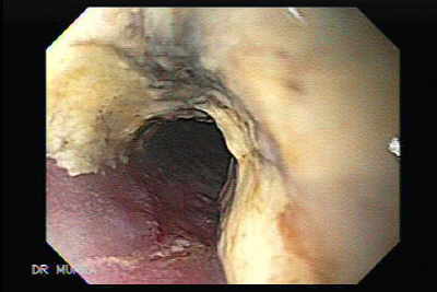 Carcinoma de células pequeñas del pulmón que infiltra
