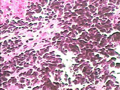 Carcinoma de células pequeñas del pulmón que infiltra