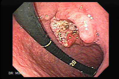 Adenocarcinoma Gástrico Ulcerado.