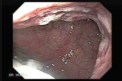 Se observa la neoplasia gástrica través del cardias