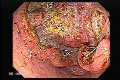 Adenocarcinoma Gástrico Ulcerado