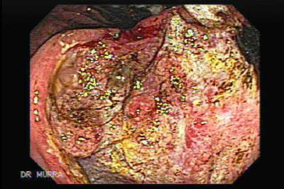 Extenso Adenocarcinoma Gástrico Ulcerado