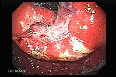 Adenocarcinoma del cardias y fondo gástrico