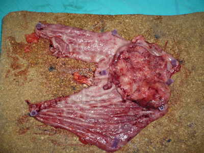 esófago-gastrectomía