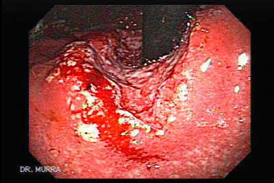 Adenocarcinoma del cardias y fondo gástrico