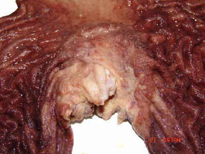Pieza Macroscópica, Hay una ulceración maligna en la unión gastroesofágica. 