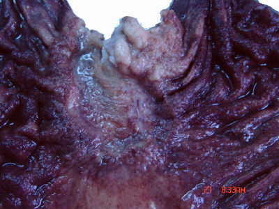 Se aprecia el fondo de la neoplasia irregular y granular.
