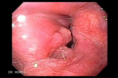 Carcinoma epidermoide de laringe