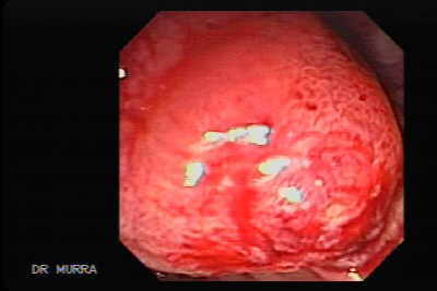 Adenocarcinoma de la papila de Váter