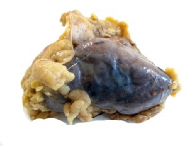 Gallbladder Adenocarcinoma litiasis.