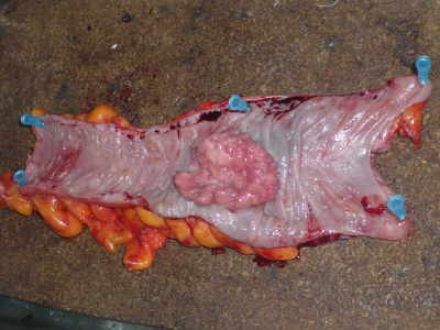 Especimen Quirúrgico Neoplasia del Colon
