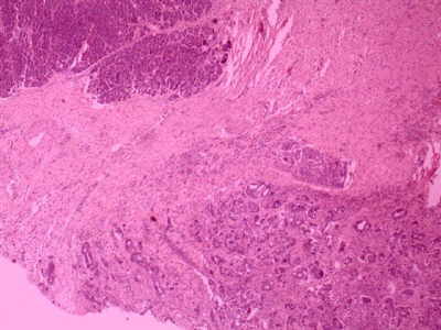 El Estudio Histopatológico de colangiocarcinoma distal