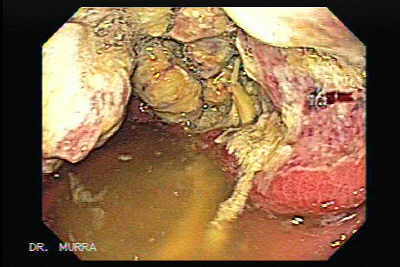 Extenso Adenocarcinoma Gástrico Ulcerado