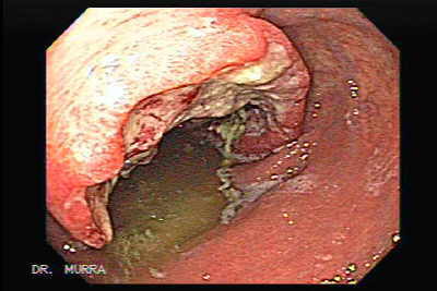 Extenso Adenocarcinoma Gástrico Ulcerado.