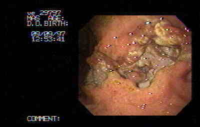 Extenso carcinoma ulcerado del cuerpo gástrico que