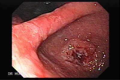 Adenocarcinoma Ulcerado del Antro Pre-Pilórico