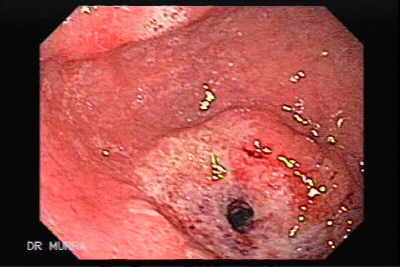 Adenocarcinoma Ulcerado del Antro Pre-Pilórico
