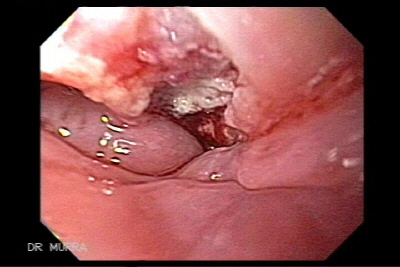 Imagen Endoscopica de Cancer del Esofago
