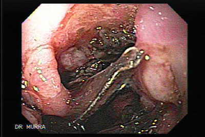 stent Esofago