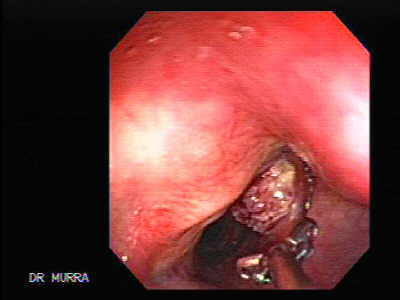 Carcinoma epidermoide de la laringe