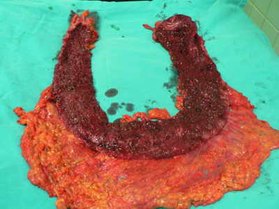 Colitis Ulcerosa Grave espécimen quirúrgico