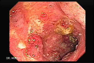 Caso de Colitis Ulcerosa Grave