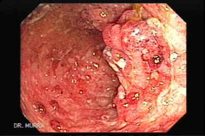 Colitis Ulcerosa severa con pseudopólipos
