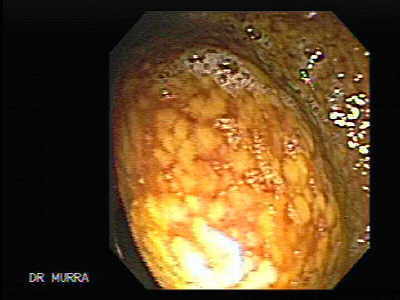 Colitis Ulcerosa complicada con Colitis pseudomembranosa del colon derecho.