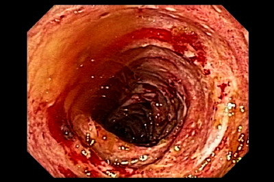Amilodosis del colon