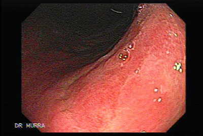 Gastritis Crónica.