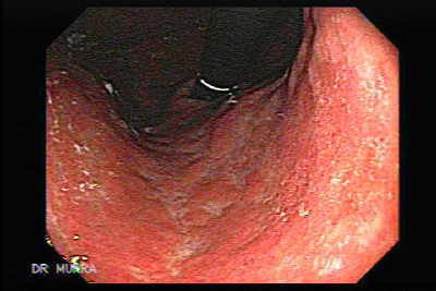 Endoscopia de Gastritis Crónica
