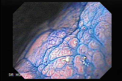 Endoscopia de Gastritis Crónica 