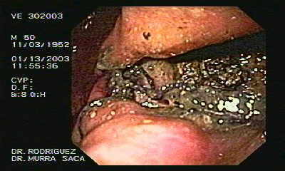 Imagen endoscópica de Cyst-Gastrostomía