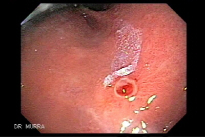 Ulceracion de Dieulafoy