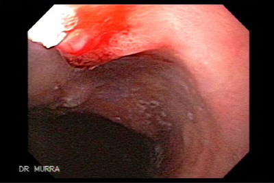 Ulceracion de Dieulafoy