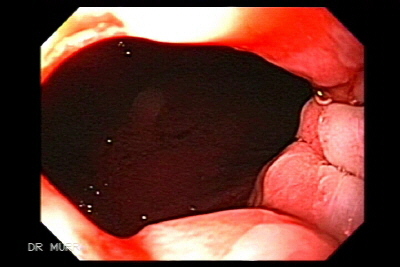 Acalasia esofago