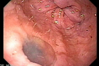 diverticulo esofago varices