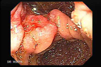 Colangiocarcinoma que infiltra el borde de un divertículo duodenal, la papila de Vater y cabeza del páncreas.
