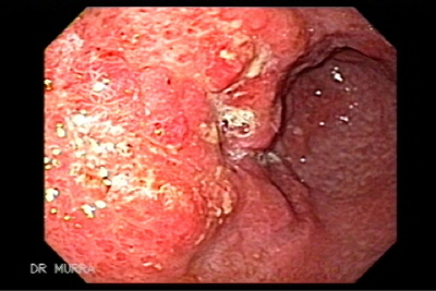 Imagen y Video de Adenocarcinoma Gastrico Sincrónico